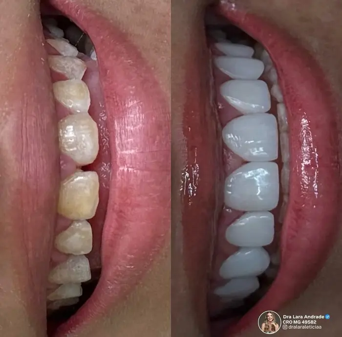 Resultado antes e depois 1