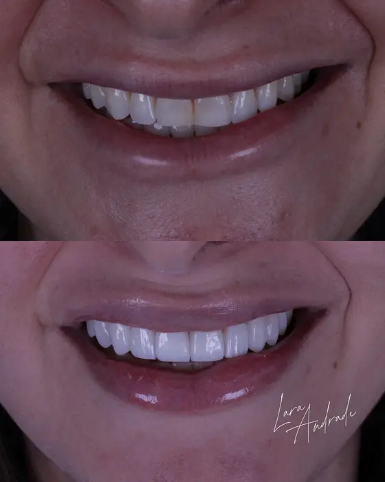 Resultado antes e depois 10