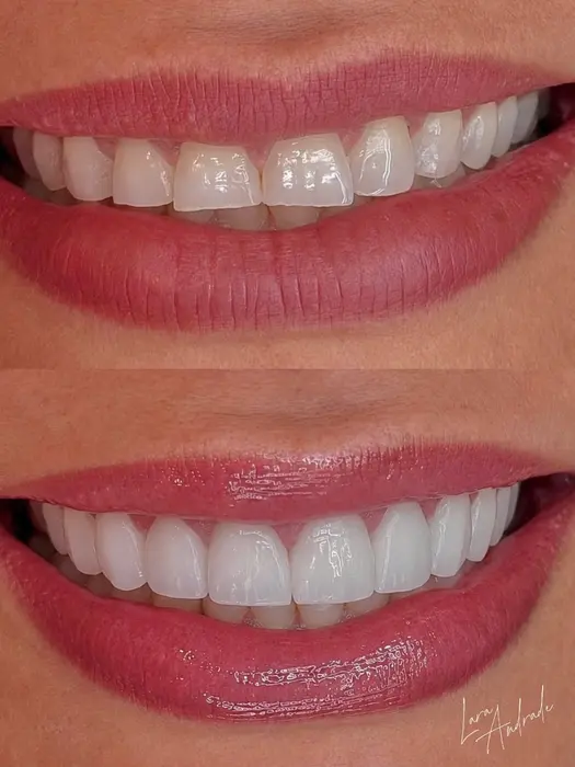 Resultado antes e depois 5